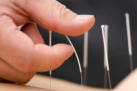 Acupuncture for treating hair loss SensingChina